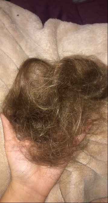 Allison Hale shows her hair that fell out after a Chemotherapy treatment.